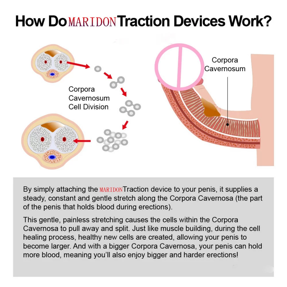how domaridontraction device work